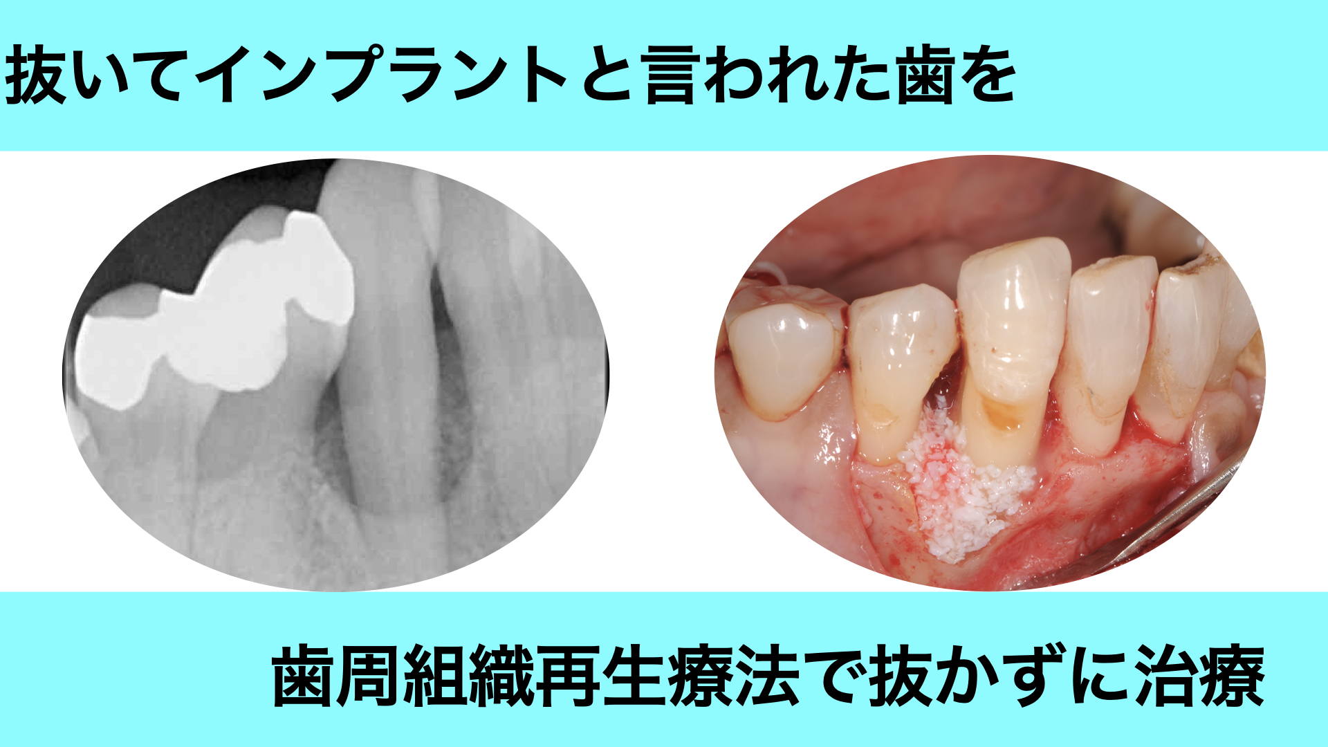 重度歯周病を再生療法で改善した症例